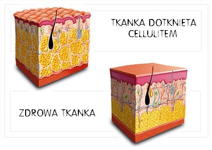 Cellulit - struktura tkanek