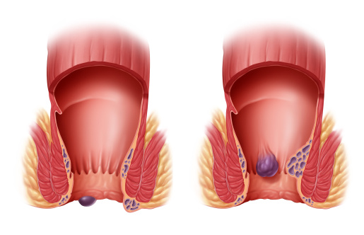 hemoroid wewnętrzny i zewnętrzny schemat